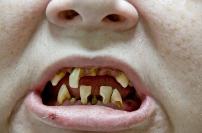 depositphotos_14363891-stock-photo-tooth-decay.jpg